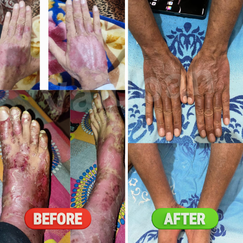 Vaidban Psoriatic Arthritis Combo Pack - Comprehensive Skin Treatment Solution